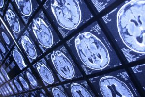 BRAIN-X-RAY - cannabis